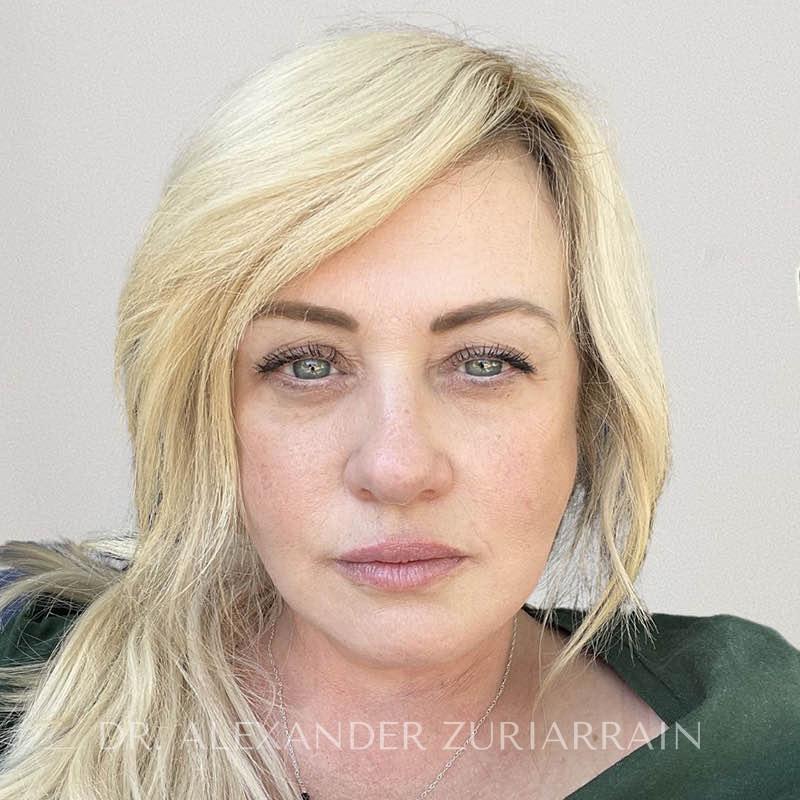 Facelift result at Zuri Plastic Surgery - Dr. Zuriarrain