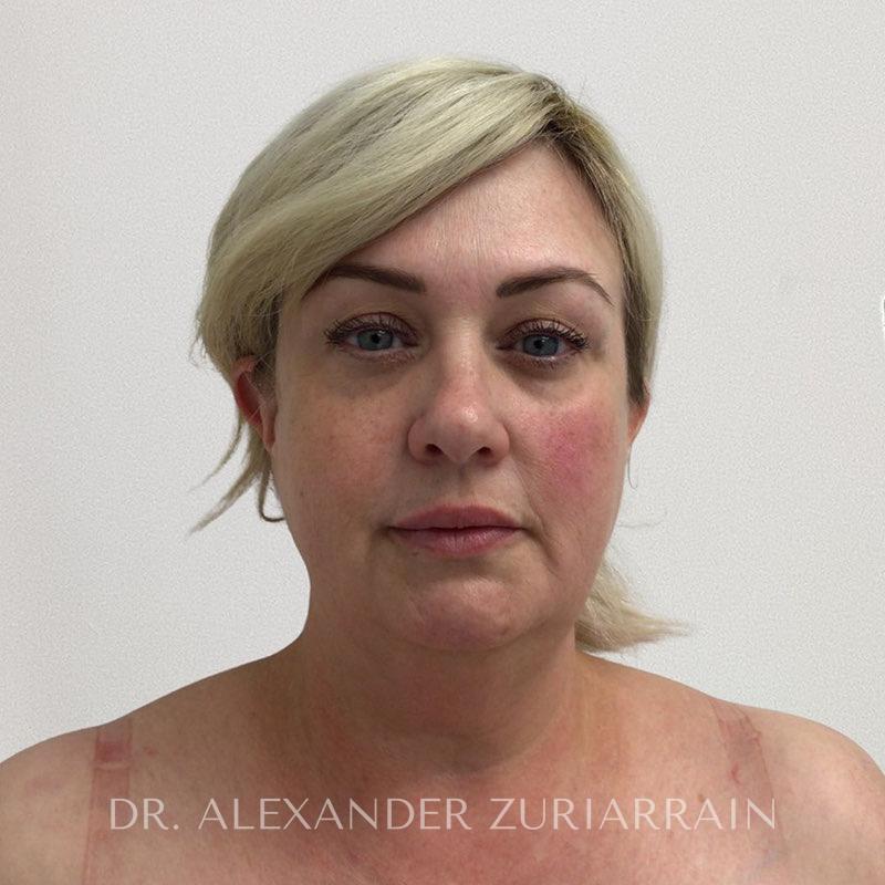 Facelift before photo