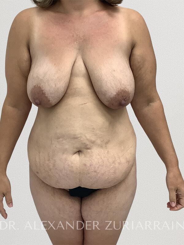 Mommy Makeover before photo
