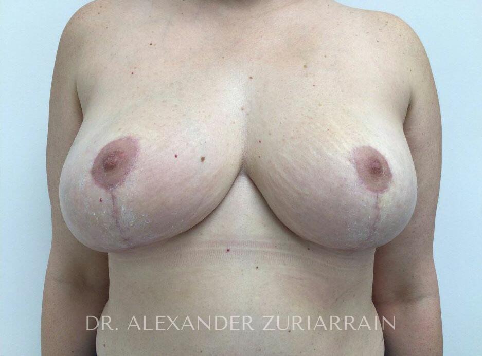 Implant Revision result at Zuri Plastic Surgery - Dr. Zuriarrain