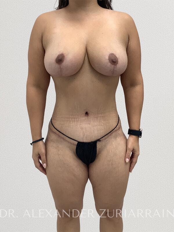 Mommy Makeover result at Zuri Plastic Surgery - Dr. Zuriarrain