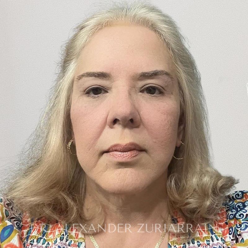 Facelift result at Zuri Plastic Surgery - Dr. Zuriarrain