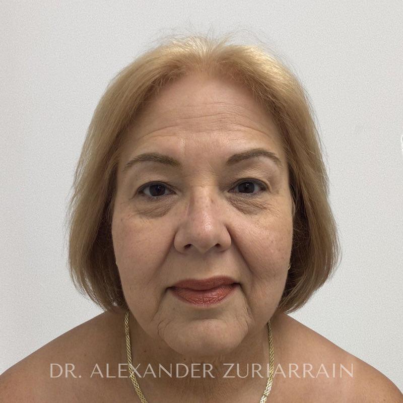 Facelift before photo