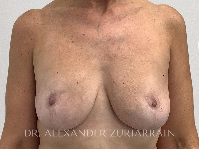 Breast Lift result at Zuri Plastic Surgery - Dr. Zuriarrain