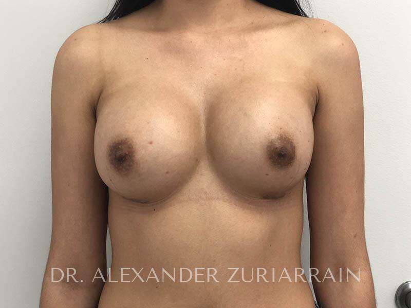 Breast Augmentation result at Zuri Plastic Surgery - Dr. Zuriarrain
