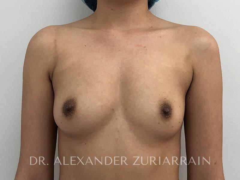 Breast Augmentation before photo
