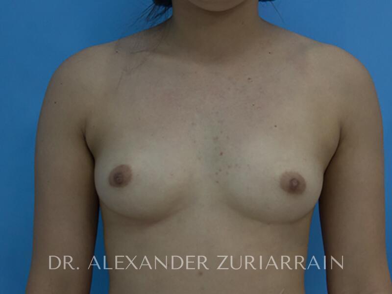Breast Augmentation before photo