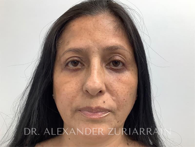 Blepharoplasty result at Zuri Plastic Surgery - Dr. Zuriarrain