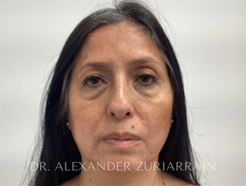 Blepharoplasty before photo