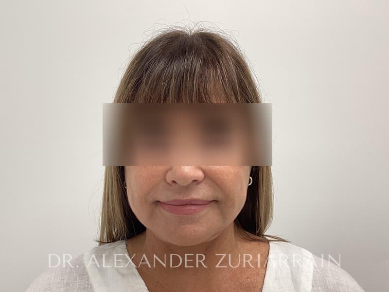 Facelift result at Zuri Plastic Surgery - Dr. Zuriarrain