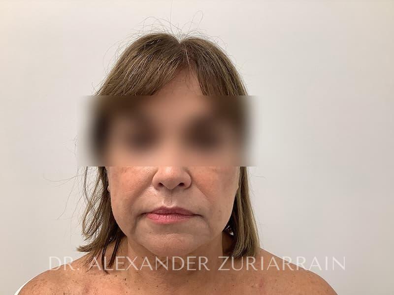 Facelift before photo