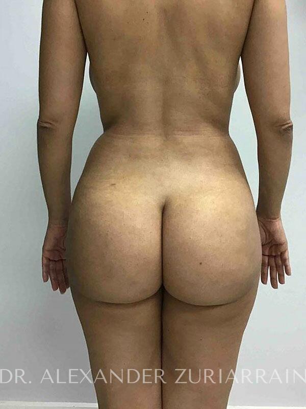 Bbl result at Zuri Plastic Surgery - Dr. Zuriarrain