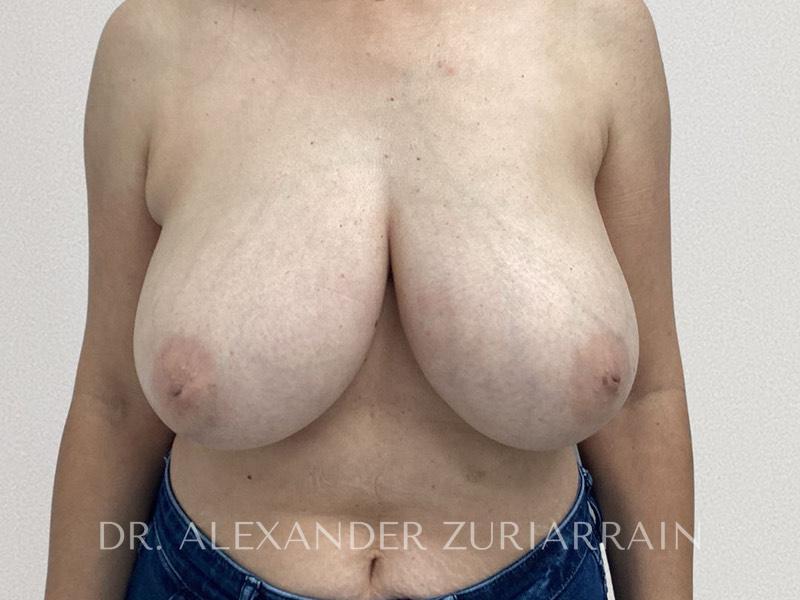Breast Reduction before photo