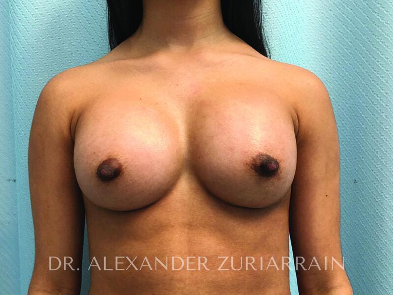 Breast Augmentation result at Zuri Plastic Surgery - Dr. Zuriarrain