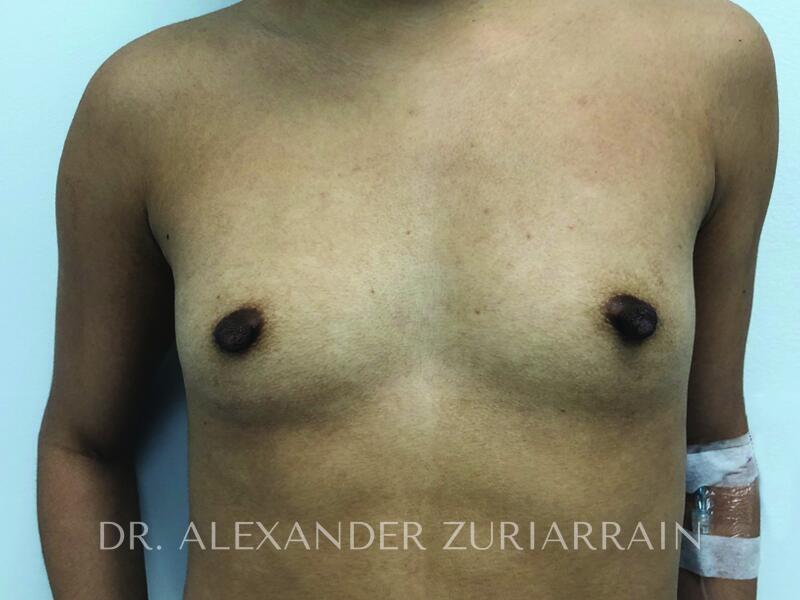 Breast Augmentation before photo
