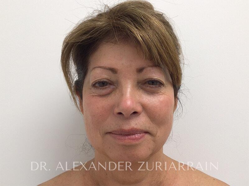 Blepharoplasty before photo