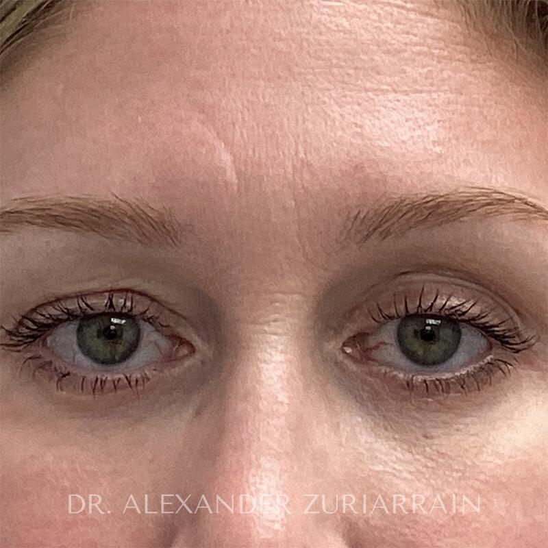 Blepharoplasty result at Zuri Plastic Surgery - Dr. Zuriarrain