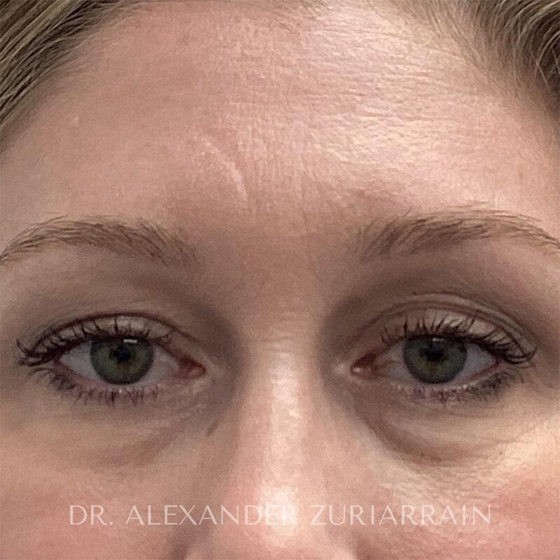Blepharoplasty before photo
