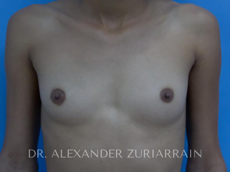 Breast Augmentation before photo