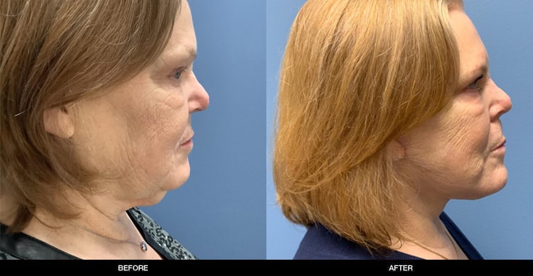 A result from Refine MD, Northwest
