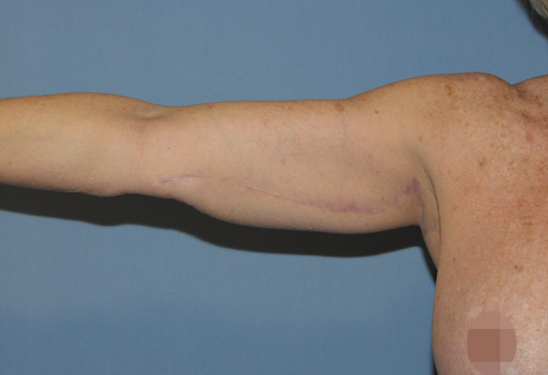 A result from Scottsdale Plastic Surgery