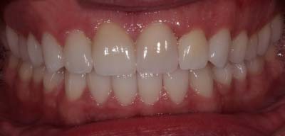 A result from Signature Smiles Dentistry of Plano