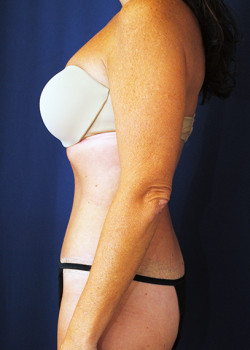 Tummy Tuck result at Watterson Plastic Surgery