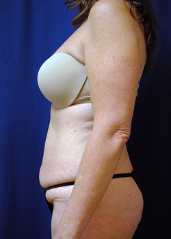 Tummy Tuck before photo