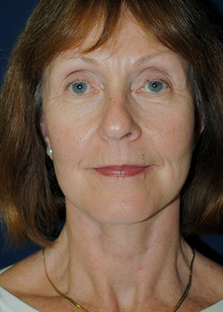 Watterson Plastic Surgery facelift after — Draper, UT