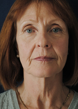 Facelift