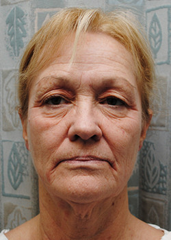 Blepharoplasty before photo