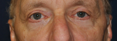 Blepharoplasty result at Watterson Plastic Surgery
