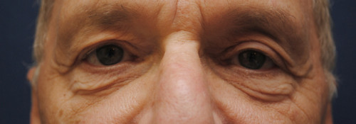 Blepharoplasty before photo