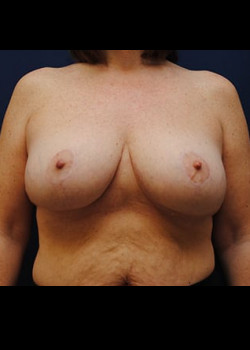 Breast Reduction result at Watterson Plastic Surgery