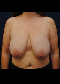 Breast Reduction