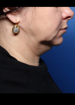 Procedure before photo