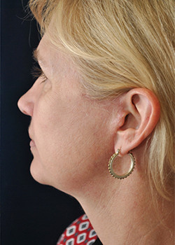 A result from Watterson Plastic Surgery