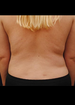 Liposuction result at Watterson Plastic Surgery