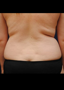Liposuction before photo