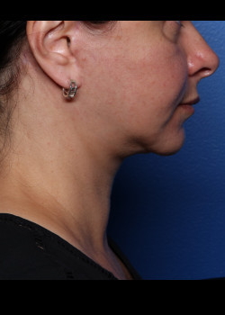 Watterson Plastic Surgery facelift after — Draper, UT