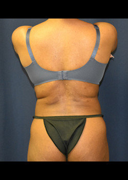 Liposuction result at Watterson Plastic Surgery