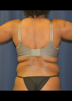 Liposuction before photo