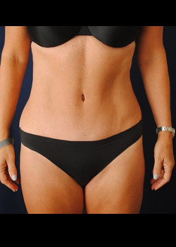 Tummy Tuck result at Watterson Plastic Surgery