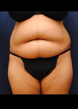 Tummy Tuck before photo