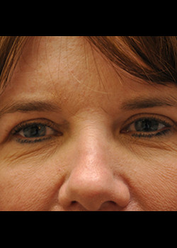 Blepharoplasty result at Watterson Plastic Surgery