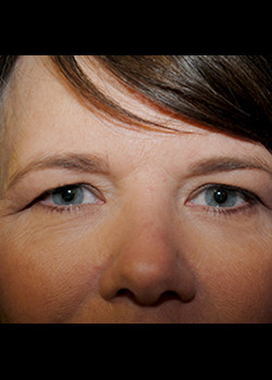 Blepharoplasty before photo