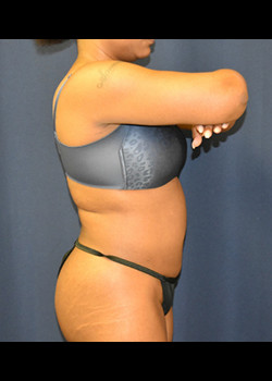 Liposuction result at Watterson Plastic Surgery