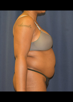 Liposuction before photo