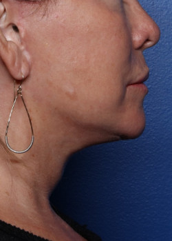 Watterson Plastic Surgery facelift after — Draper, UT
