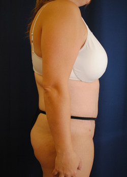 Tummy Tuck result at Watterson Plastic Surgery